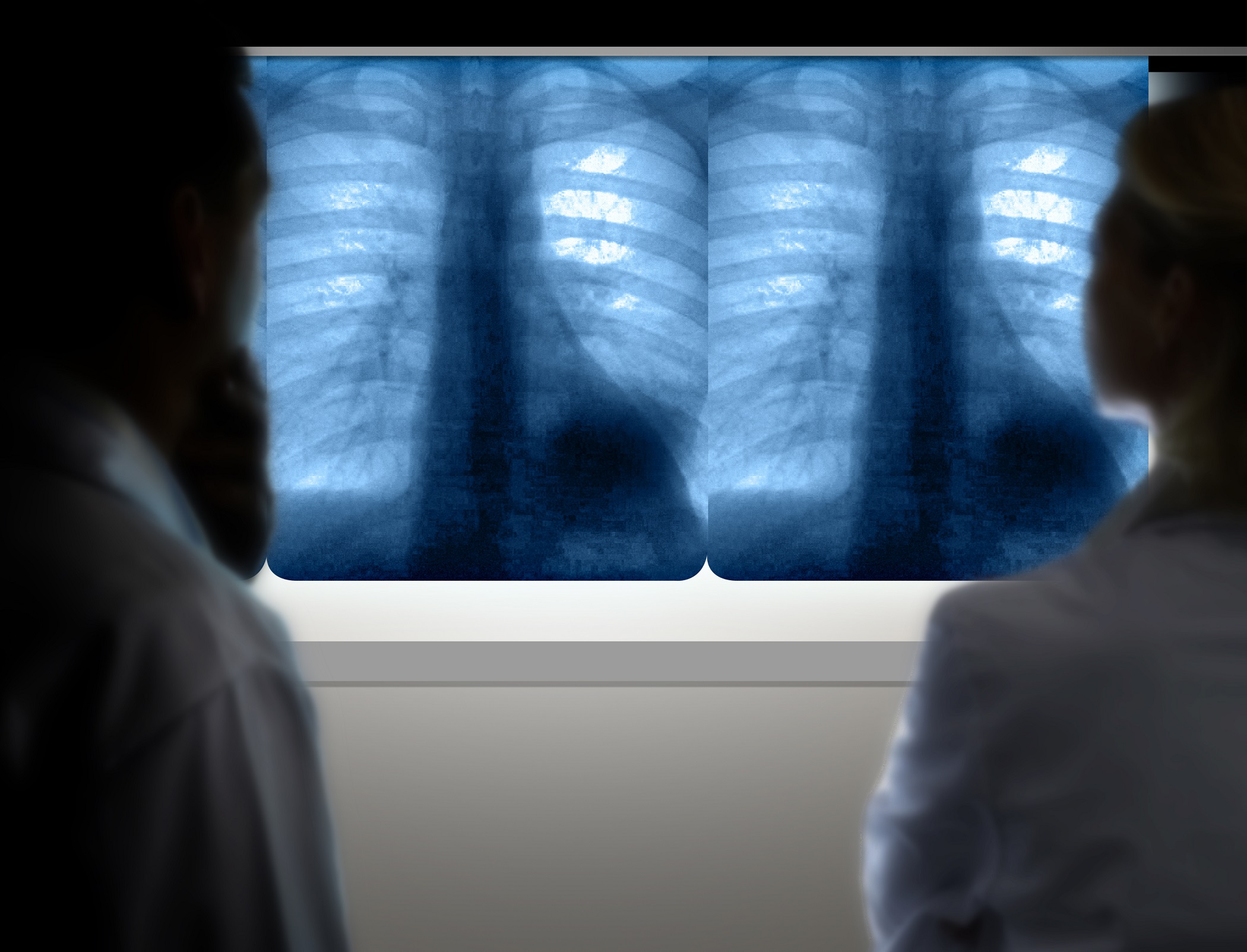 AI used to identify lung cancer vulnerabilities