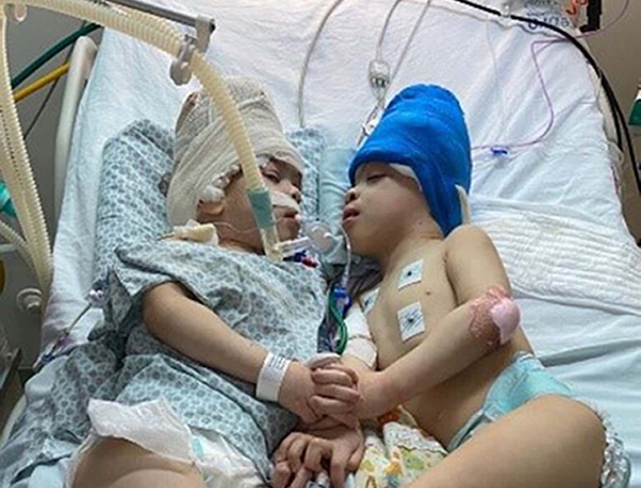 Virtual reality helps separate conjoined twins with fused brains