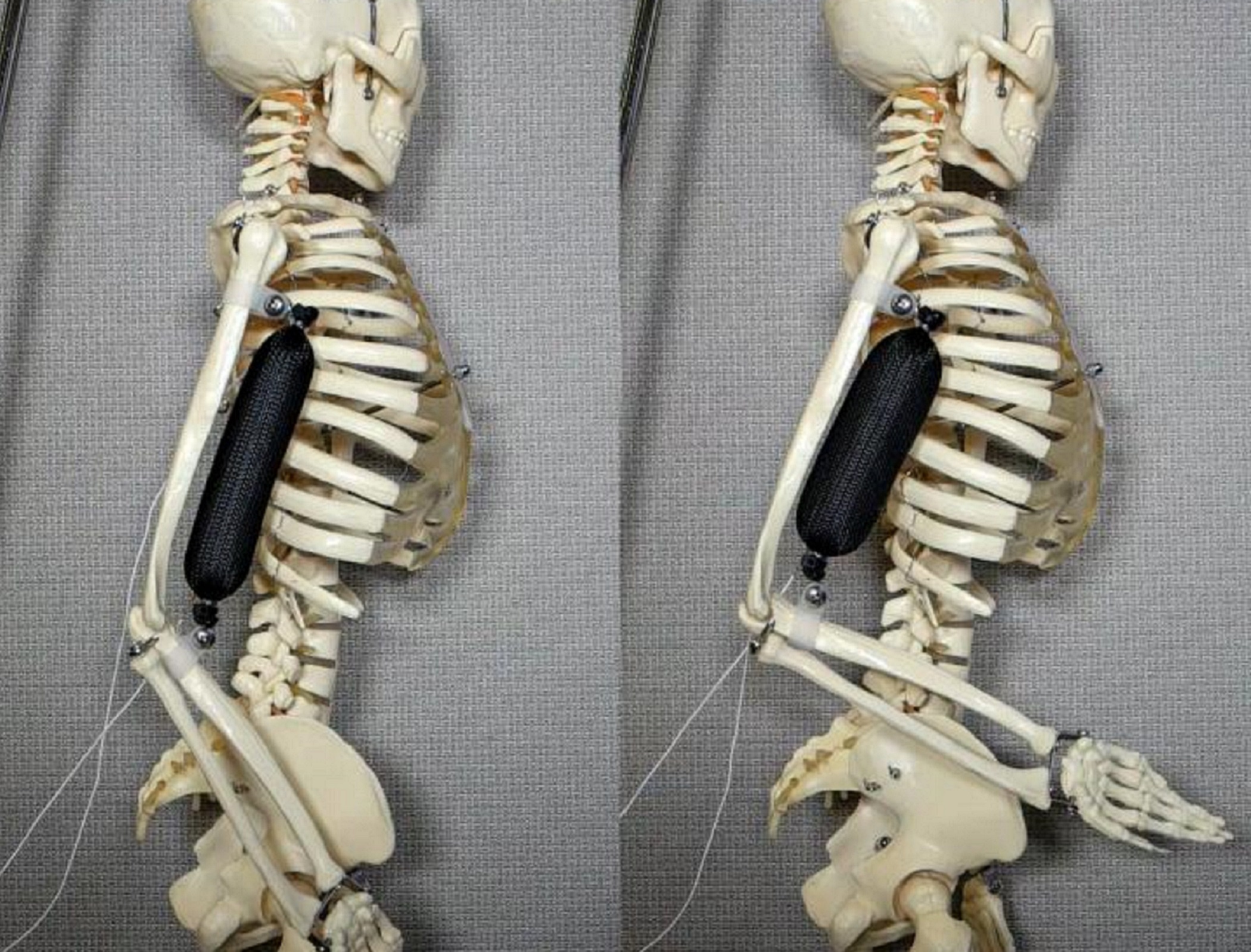 Upper-body mobility suit project to help people with neuromuscular diseases