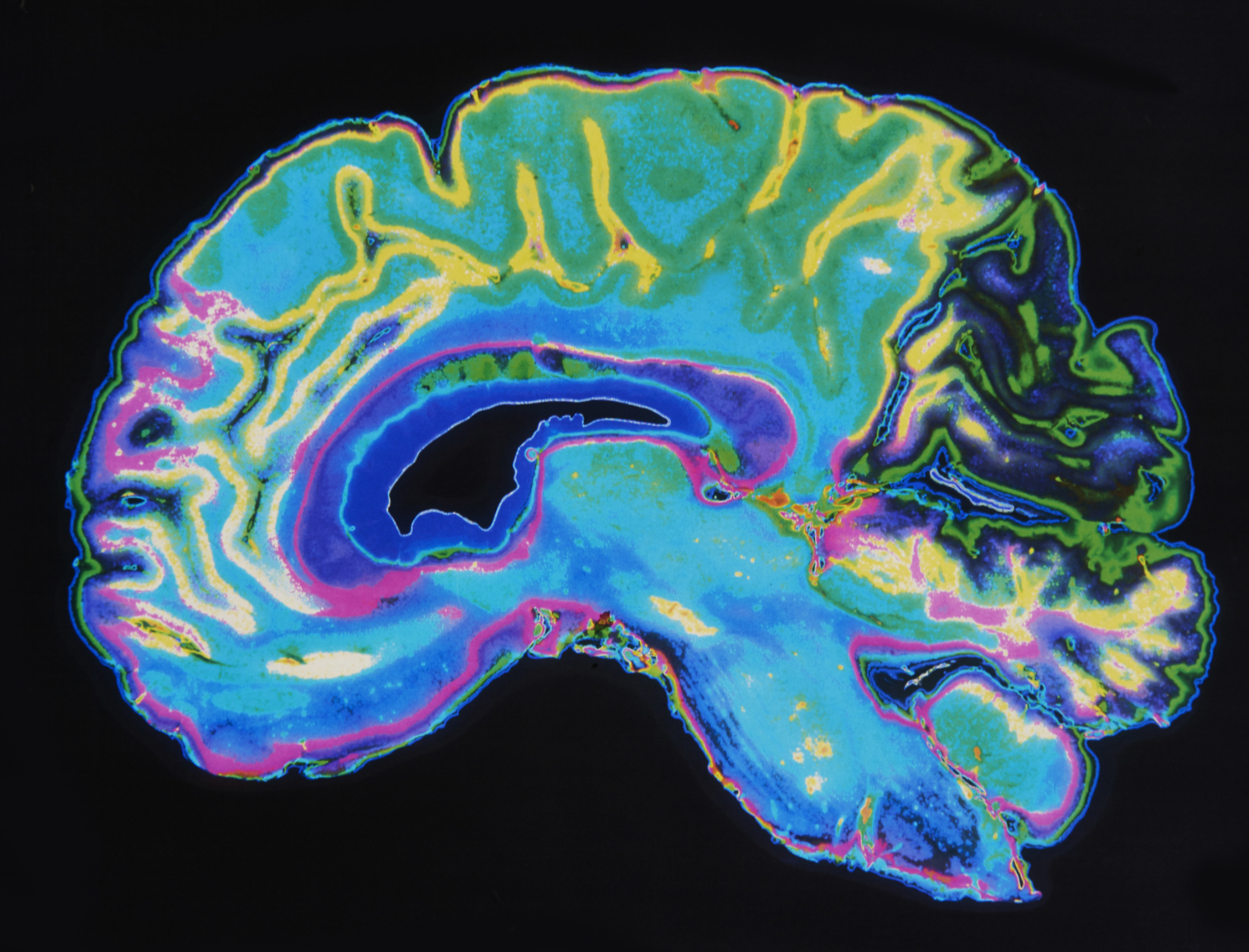 AI could detect Alzheimer's disease from brain scans