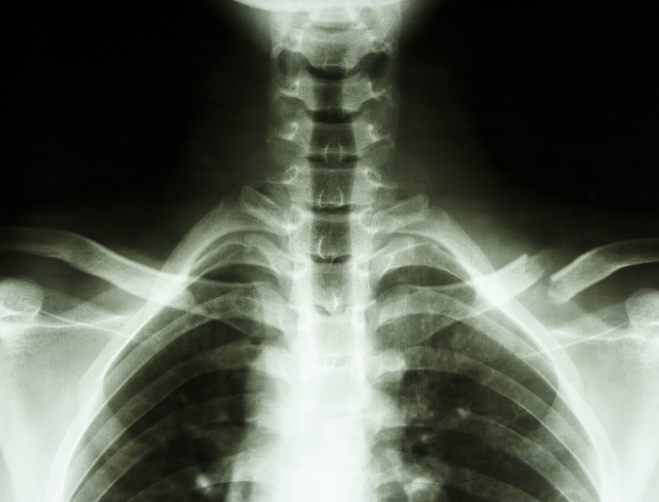 AI can predict bone fractures in cancer patients
