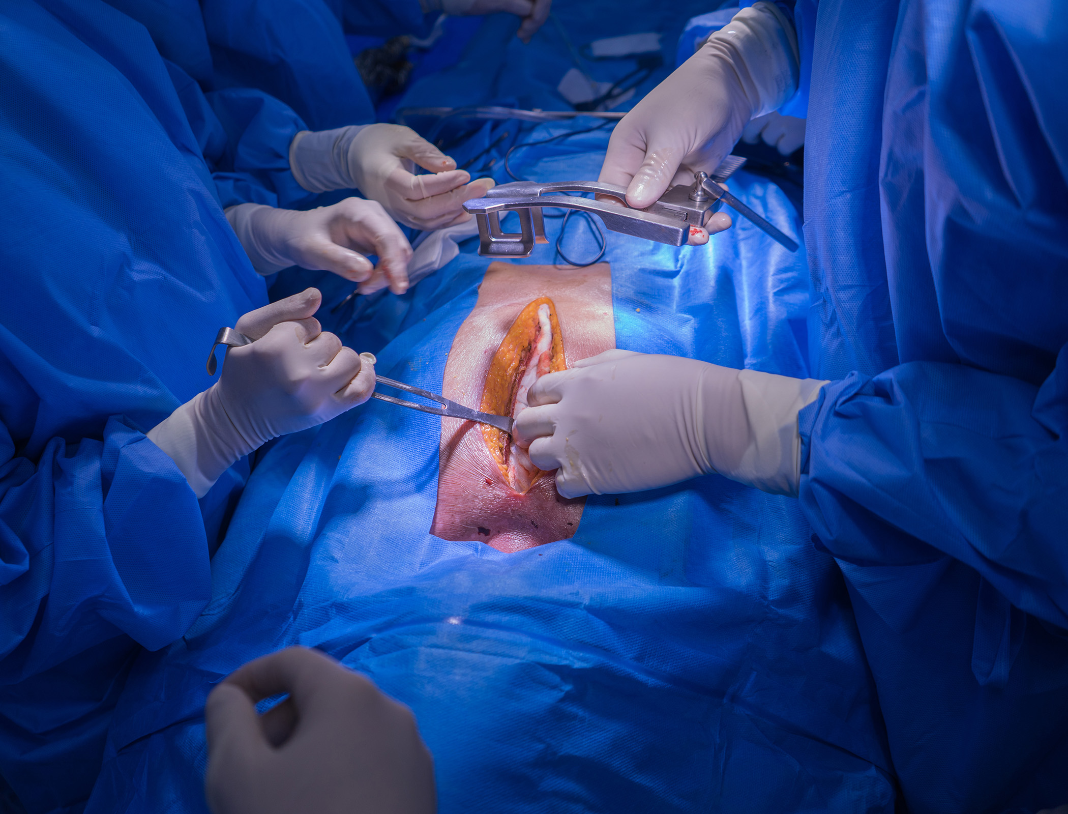 Blood test for ‘zombie’ heart cells could help to boost organ transplants