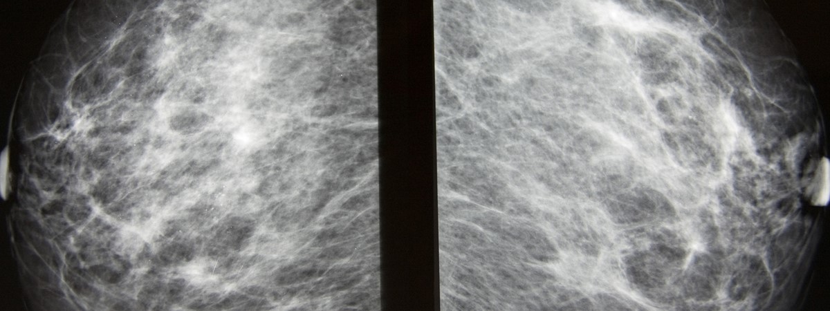 AI mammogram reader approved for use in Irish healthcare system