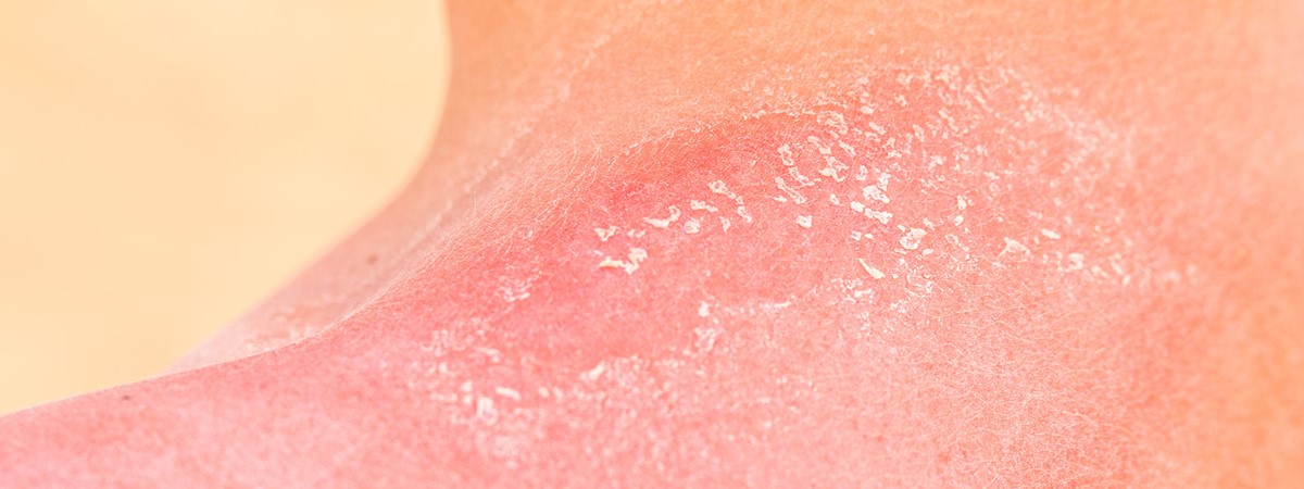 Handheld 3D skin printer can heal burn victims in situ