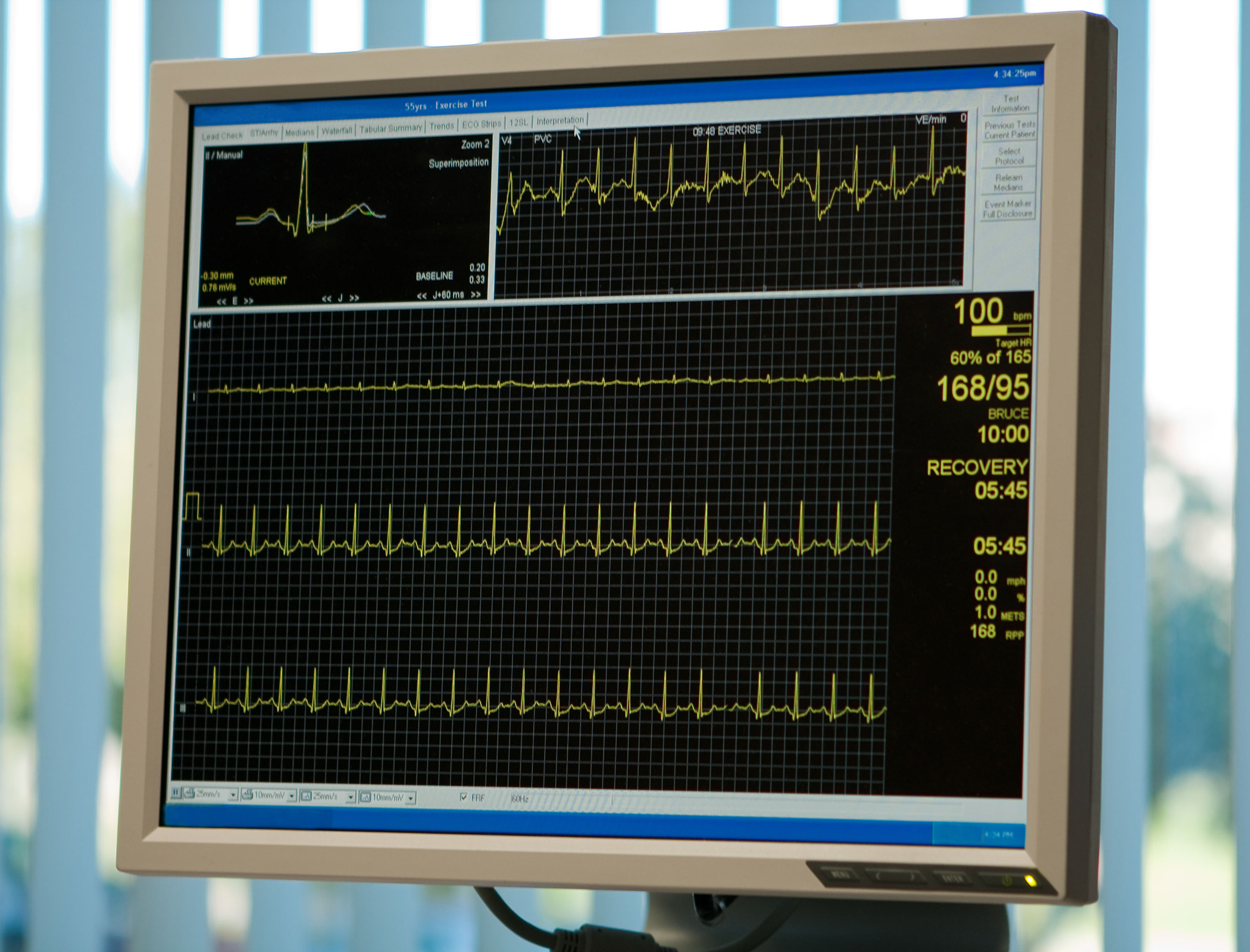 Smartphone turned into blood pressure monitor using low-cost plastic clip