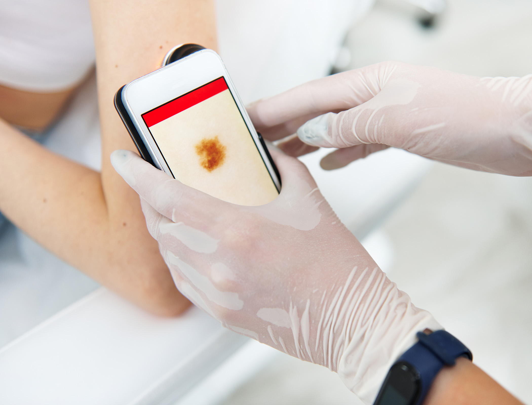 NHS adopts lens technology for smartphone skin cancer assessments
