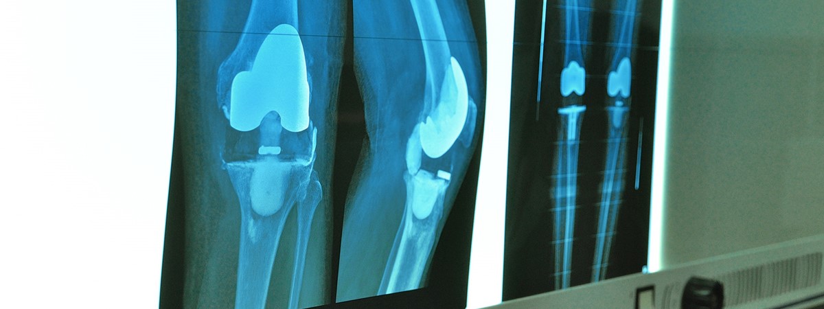 3D-printed knee implants made of metal could cut decades of pain