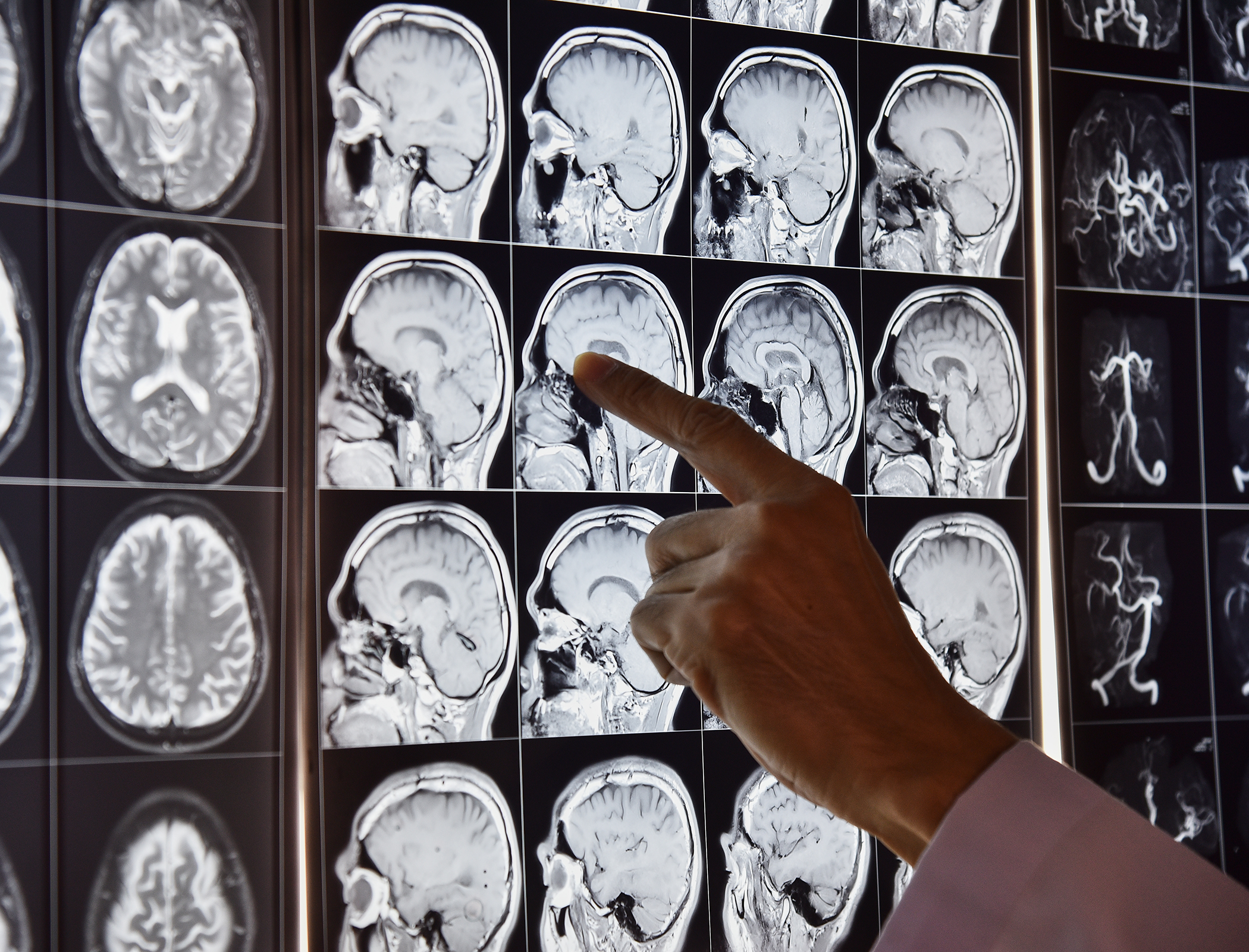 Algorithm that detects brain defects could help treat epilepsy