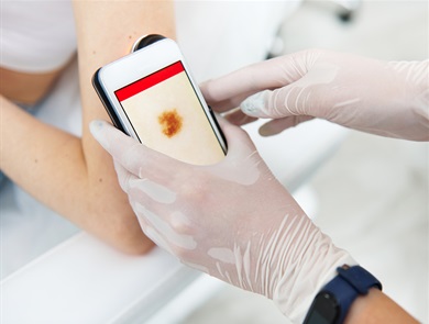 NHS adopts lens technology for smartphone skin cancer assessments